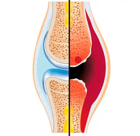 A estrutura dunha articulación sa e desgastada coa designación de tecido cartilaginoso e líquido sinovial